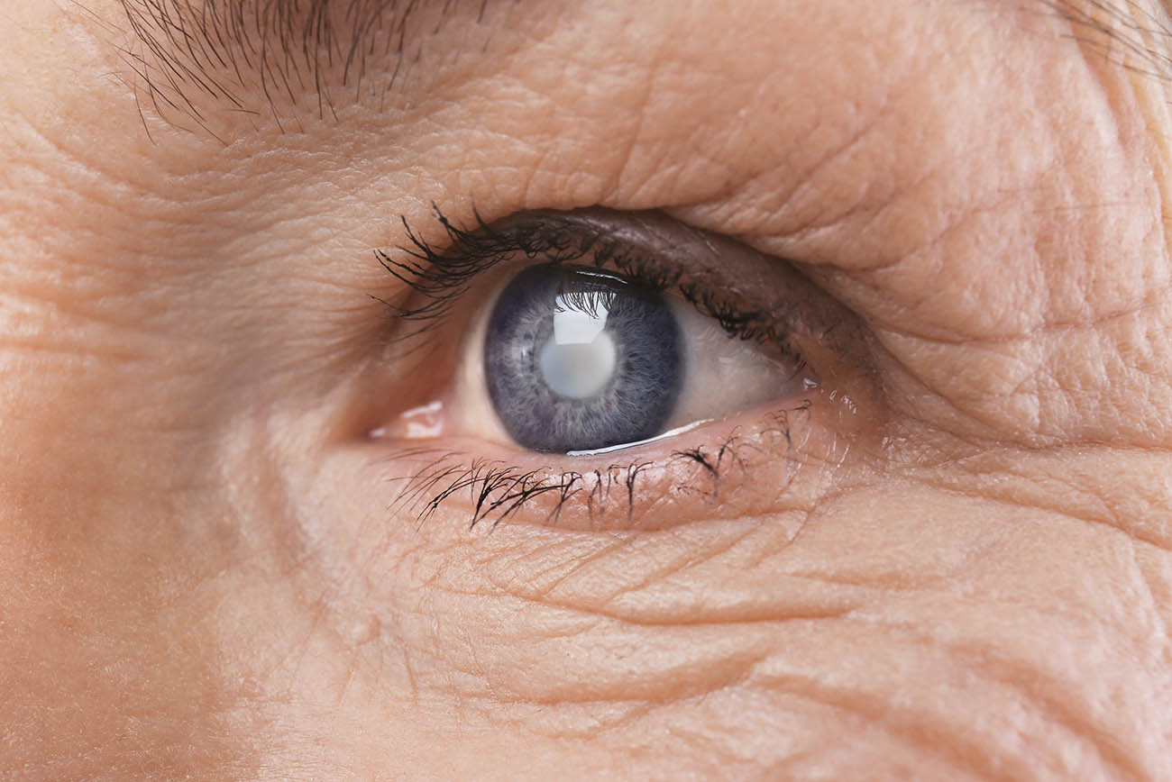 Maintaining Transparency: Study to Focus on Causes of Cataracts - The University of Arizona Health Sciences |