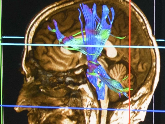 The Center for Innovation in Brain Science is leading the way in the fight against Alzheimer’s, Parkinson’s, multiple sclerosis and amyotrophic lateral sclerosis (ALS), neurodegenerative diseases that affect millions of people worldwide.