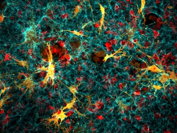 Confocal cancer cells and fibroblasts in collagen.