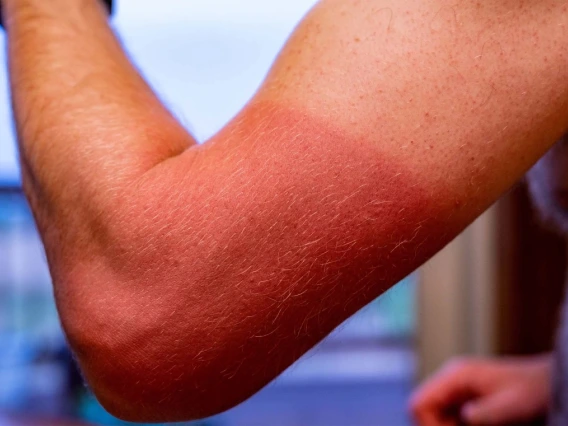 A man's arm is shown with a slight sunburn below the bicep while the upper part of the arm is in its natural color.