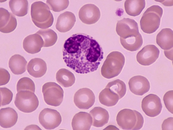 A microscopic view of cells shows one large purple cell surrounded by smaller "normal" cells. The purple cell is about four times the size of the normal cells.