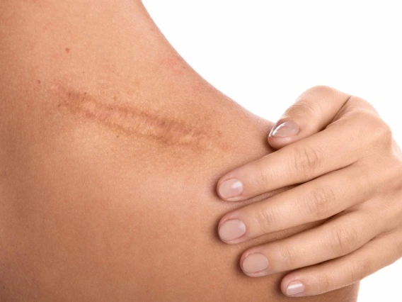 A closeup of a long scar on a woman's shoulder.