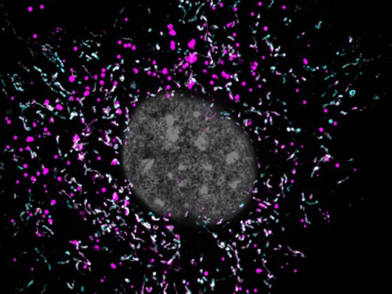 When an astrocyte’s mitochondria (magenta) are impaired, they are unable to break down lipid waste (cyan), and the buildup of extra fat (white spots) might be accelerating the progression of Alzheimer’s disease.