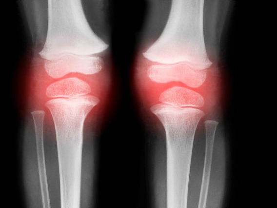 No treatments are currently available to prevent osteoarthritis or halt its progression, due in part to challenges in identifying knees at highest risk for structural progression. A new study will examine x-rays to help predict rapid knee deterioration, as well as the need for knee replacement.