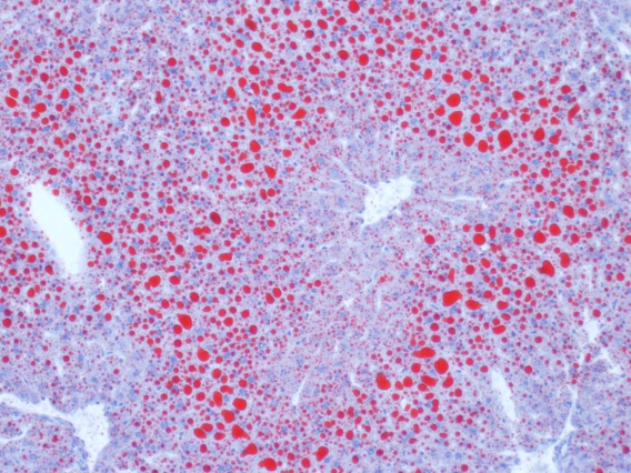 A frozen section of fatty liver reveals itself under the microscope after being treated with a red dye that stains lipids (Oil Red O), and a blue dye that exposes the nuclei. The stain was performed by the late Andrea Grantham, senior research specialist at the RII Imaging Core on the Health Sciences campus. Image submitted by Douglas Cromey, MS, associate scientific investigator in the College of Medicine – Tucson.