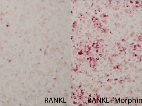 On the left, cells isolated from breast cancer cells were treated with RANKL, a growth factor that stimulates bone resorption, to produce osteoclasts (pink). When morphine was added to the cell culture (right), the number of osteoclasts increased, suggesting that morphine stimulated osteoclast production.