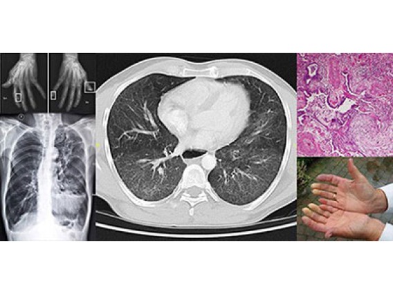 A collage of images showing the impact of scleroderma, including thickening and hardening of skin, joint and vascular issues, and progressive scarring in organs, particularly in the lungs. Pulmonary fibrosis affects 90 percent of scleroderma patients and is the leading cause of death.