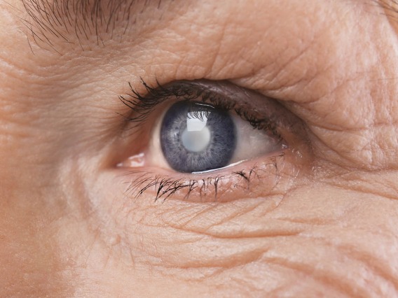 University of Arizona College of Medicine – Tucson researchers are working to identify the mechanisms that cause cataracts in the hopes of developing new targets for potential treatments.