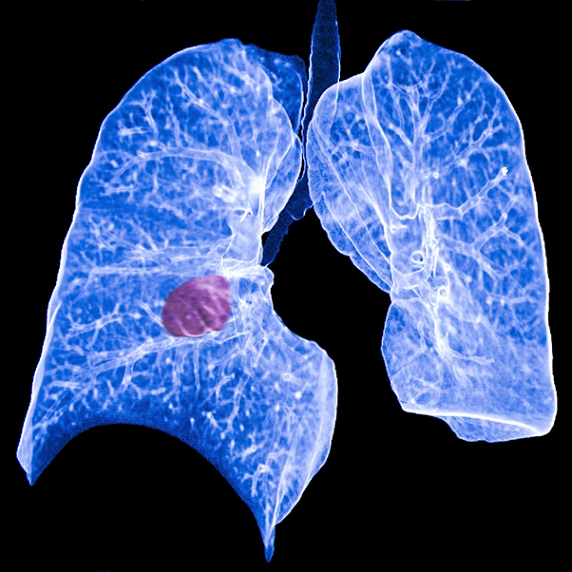 Lungs