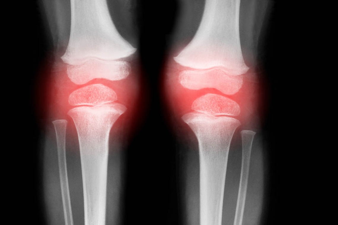 No treatments are currently available to prevent osteoarthritis or halt its progression, due in part to challenges in identifying knees at highest risk for structural progression. A new study will examine x-rays to help predict rapid knee deterioration, as well as the need for knee replacement.