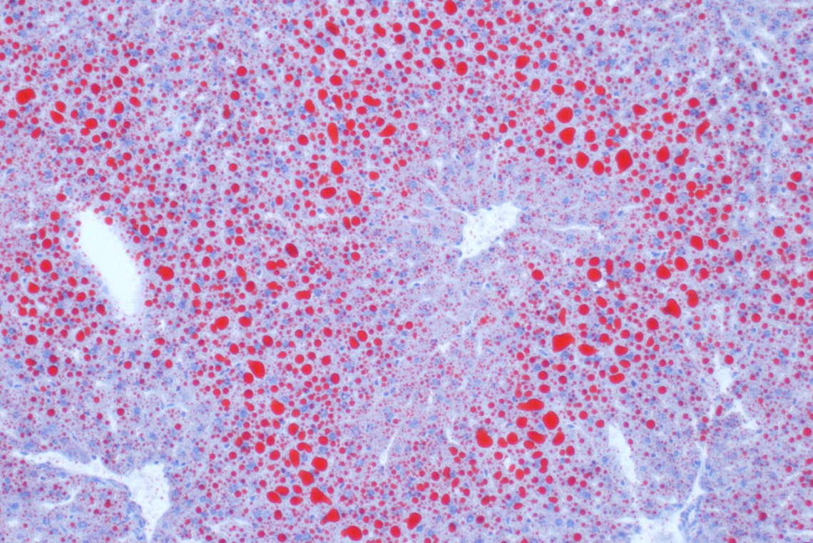 A frozen section of fatty liver reveals itself under the microscope after being treated with a red dye that stains lipids (Oil Red O), and a blue dye that exposes the nuclei. The stain was performed by the late Andrea Grantham, senior research specialist at the RII Imaging Core on the Health Sciences campus. Image submitted by Douglas Cromey, MS, associate scientific investigator in the College of Medicine – Tucson.