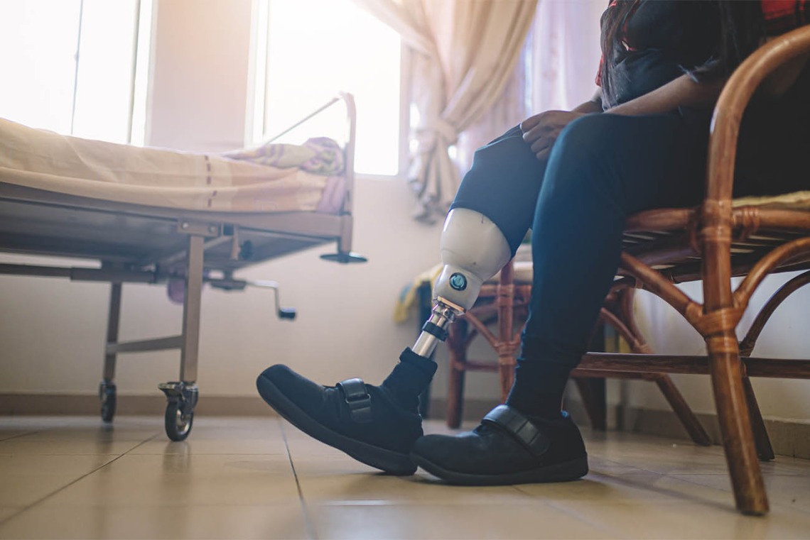 Expanded access to insurance coverage was accompanied by an improvement in limb salvage care, according to the results of a study led by University of Arizona Health Sciences researchers.