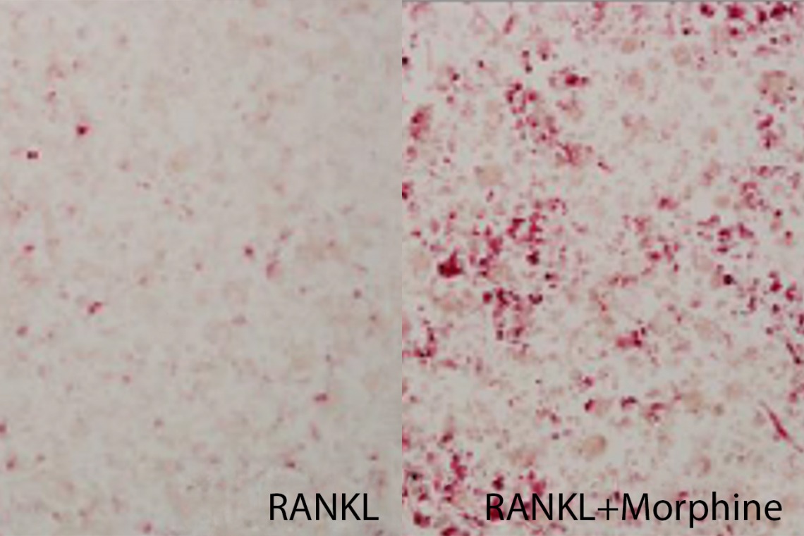 On the left, cells isolated from breast cancer cells were treated with RANKL, a growth factor that stimulates bone resorption, to produce osteoclasts (pink). When morphine was added to the cell culture (right), the number of osteoclasts increased, suggesting that morphine stimulated osteoclast production.