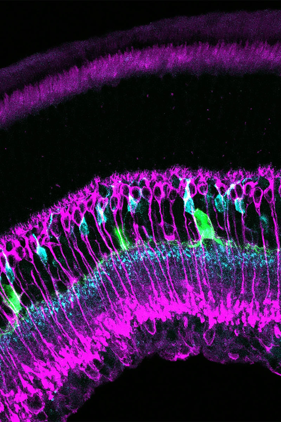 Scientists are studying images taken under a microscope, such as this image from diabetic and control retinas, to understand the cellular changes that occur in the early stages of diabetes, before vision loss occurs. This image shows rod bipolar cells in magenta, some cone bipolar cells in cyan, and dopaminergic amacrine cells in green.