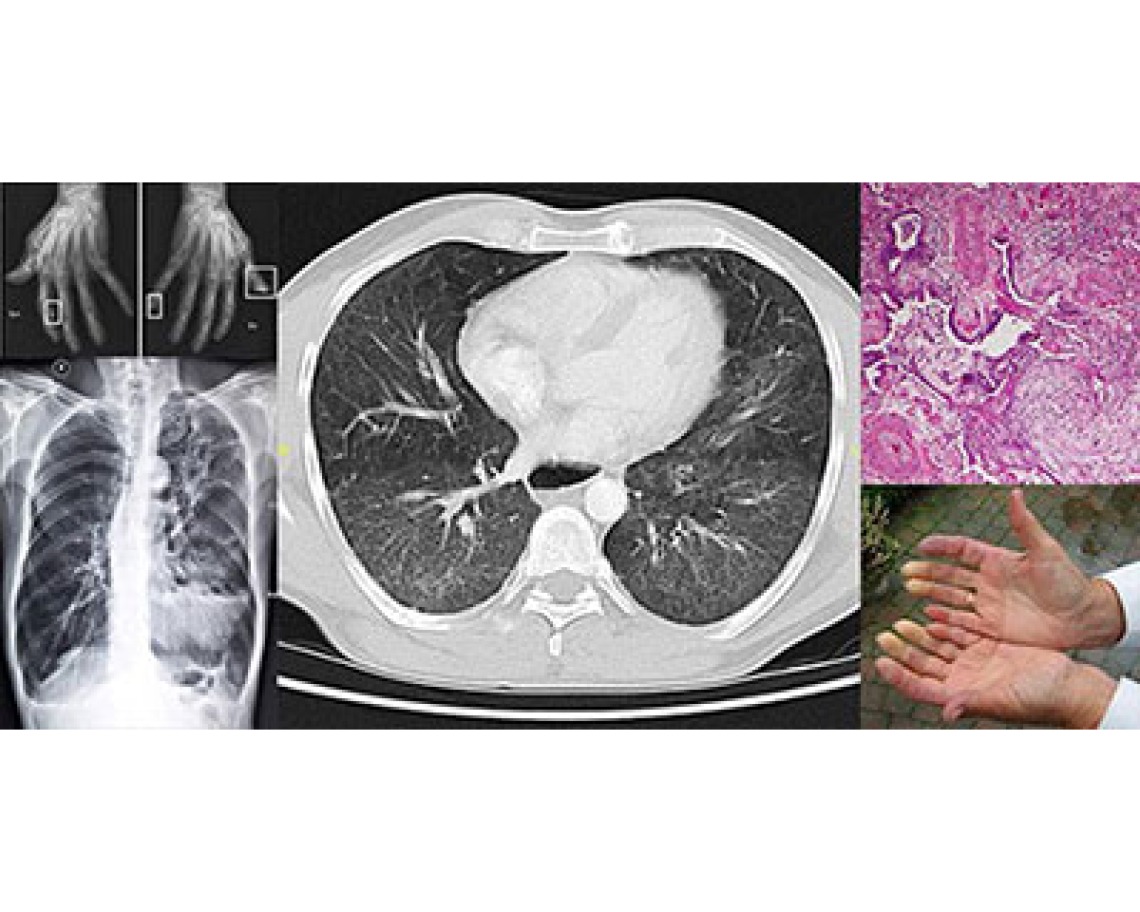 A collage of images showing the impact of scleroderma, including thickening and hardening of skin, joint and vascular issues, and progressive scarring in organs, particularly in the lungs. Pulmonary fibrosis affects 90 percent of scleroderma patients and is the leading cause of death.