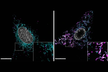 Lipid accumulation in a normal astrocyte (left) is compared with an astrocyte with dysfunctional mitochondria (right). The mitochondrial network is labeled in magenta and lipids accumulated within cells are labeled in cyan. White spots mark undegraded lipids trapped at the mitochondria.