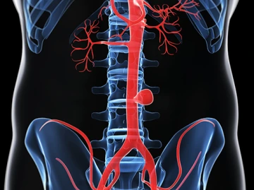 Aortic aneurysm, artwork