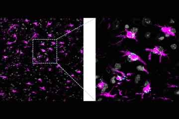 Lipids accumulation in a brain with dysfunctional astrocytic mitochondria. Astrocytes are labeled in magenta and lipids accumulated within cells are labeled in cyan. 